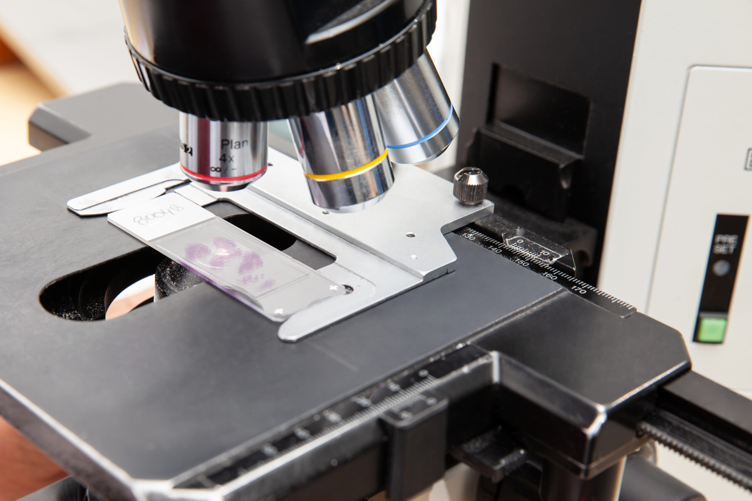 closeup of a microscope slide with stained tissue biopsy under t